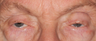 Ptosis and ectropion repair