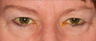 Blepharoplasty (eyelid lift)