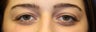 Upper Eyelid Surgery