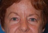 Blepharoplasty