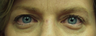 Upper lid blepharoplasty