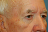 Eyelid Surgery