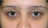 Lower Eyelid Blepharoplasty