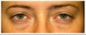 Lower Eyelid Surgery