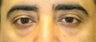 Lower Eyelid Surgery