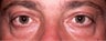 Transconjunctival Lower Eyelid Blepharoplasty