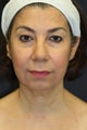 Facelift with upper/lower blepharoplasty, chin augmentation, radiesse, and buccal fat removal