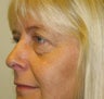 Upper and Lower Eyelid Blepharoplasty