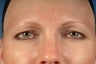 upper blepharoplasty/eyelid surgery