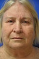 Upper blepharoplasty with ptosis correction (eyelid surgery)