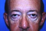 Upper and Lower Blepharoplasty