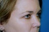 Blepharoplasty