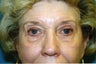 Upper and Lower Blepharoplasty
