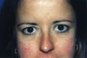 Blepharoplasty
