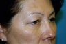 Blepharoplasty