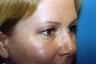 Blepharoplasty