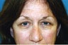 Blepharoplasty