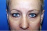 Blepharoplasty