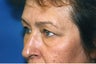 Blepharoplasty