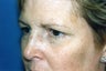 Blepharoplasty