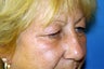 Blepharoplasty