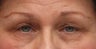 Blepharoplasty and endoscopic browlift