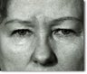 Eyelid Surgery