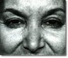 Eyelid Surgery