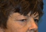 Blepharoplasty