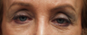 Blepharoplasty