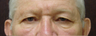 Upper Eyelid Lift