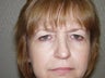 Endoscopic browlift, Upper and Lower Eyelid surgery