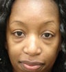 Blepharoplasty