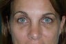 Eyelid Surgery