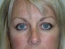 Eyelid Surgery