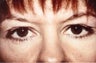 Eyelid Surgery