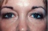Eyelid Surgery