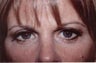 Eyelid Surgery