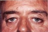 Eyelid Surgery For Men