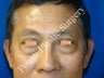 Eye Surgery (Blepharoplasty)
