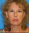 Facelift, Lower Blepharoplasty, Endoscopic Brow Lift