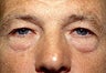 Before and After Blepharoplasty and Brow Lift