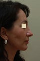 Facial Surgery for Rejuvenation