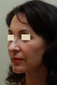 Facelift