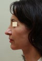 Face Lift (side view)