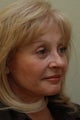 Face & Neck Lift