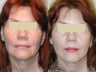 Mini jowl and neck lift - SLUPlift