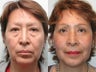 Minifacelift Blepharoplasty