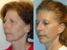 Full Facelift - Browlift, lower blepharoplasty, Lower Facelift