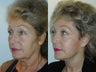 Midface lift - lower minifacelift - upper and lower blepharoplasty